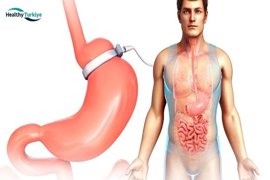 Gastric Banding